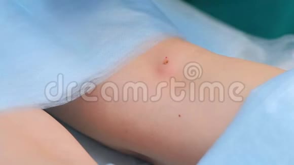 外科医生在取出痣后用石膏封住病人的腿双手特写视频的预览图