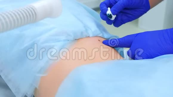 外科医生在病人背部取出的痣上涂上绿色防腐剂视频的预览图