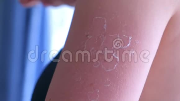 女士与剥皮皮肤从紫外线晒伤的肩膀特写视频的预览图