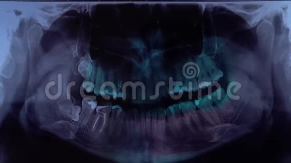 牙医看牙x光片特写检查牙弓使用计算机时的X射线图像视频的预览图