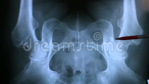 骨盆骨解剖X线视频的预览图