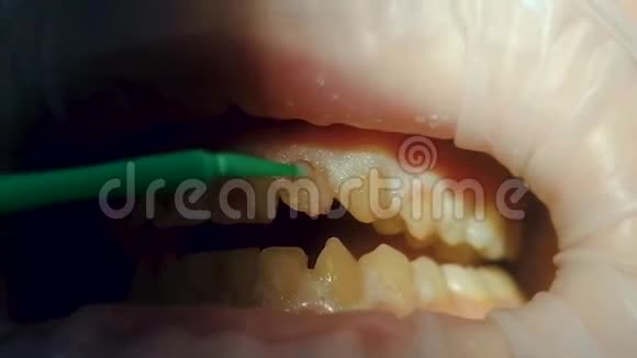 上排牙上涂抹红色美白材料于口腔视频的预览图