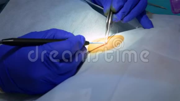 外科手术中用医疗工具和设备切除痣的专业医生视频的预览图