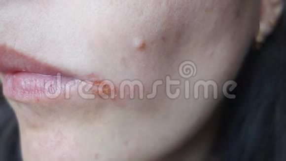 刺角球一个女孩在嘴角治疗炎症视频的预览图