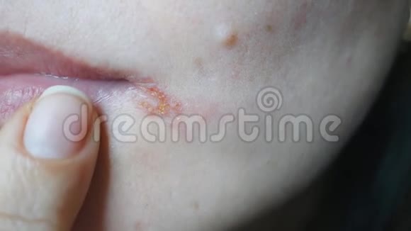 刺角球角嘴的炎症缺乏维生素弱点的概念视频的预览图