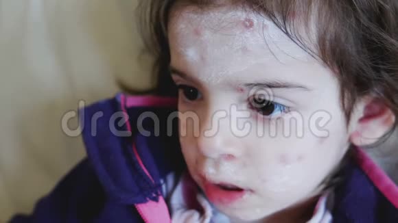 皮肤病额头儿童抗胺药膏面痘视频的预览图