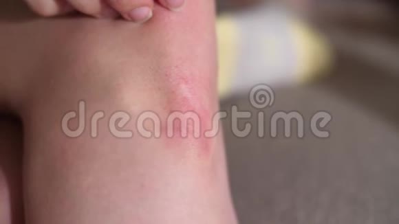 女人抓痒的红发膝盖视频的预览图