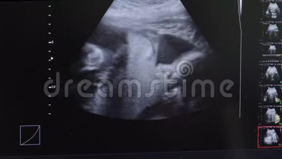 超声波监测屏幕显示母亲子宫中婴儿视频的预览图