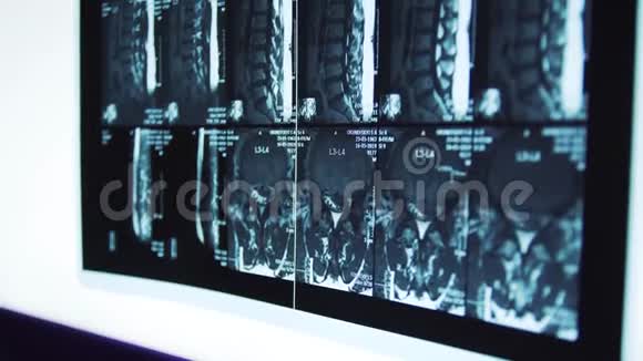 支架上脊柱的X光片健康医疗医院视频的预览图