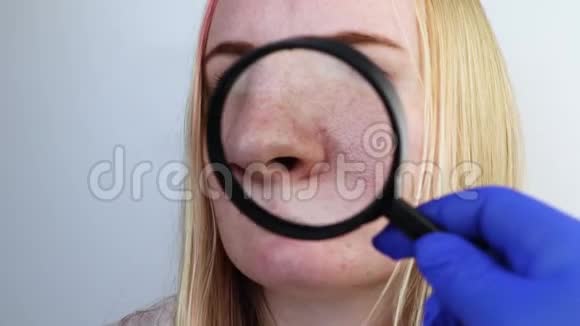 扩大酒渣鼻毛孔黑点鼻子上的痘痘特写一名妇女正在接受医生的检查皮肤科医生检查视频的预览图