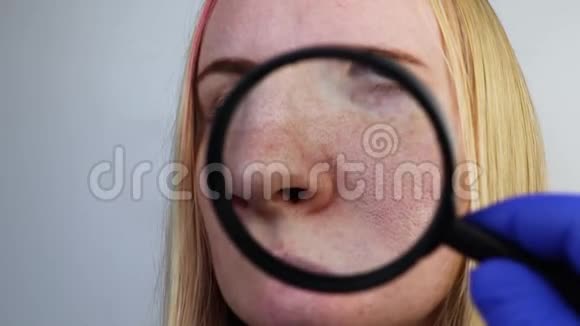 扩大酒渣鼻毛孔黑点鼻子上的痘痘特写一名妇女正在接受医生的检查皮肤科医生检查视频的预览图