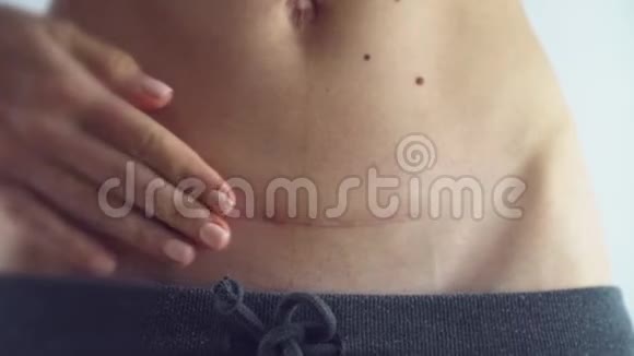 瘦小女孩分娩医学概念4k上的妇女腹部疤痕c节特写视频的预览图