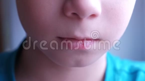 人嘴唇上的疱疹病毒小男孩唇口特写有疱疹疮视频的预览图
