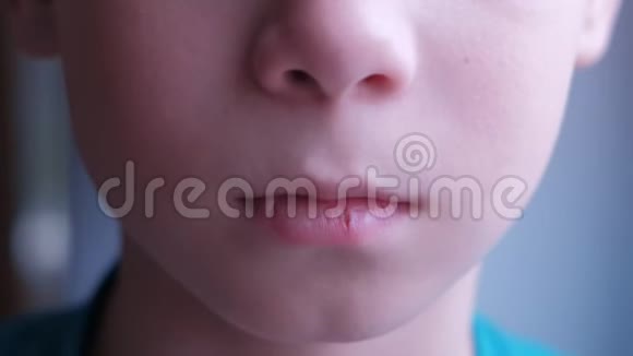 小男孩唇部疱疹性咽峡炎嘴巴特写视频的预览图