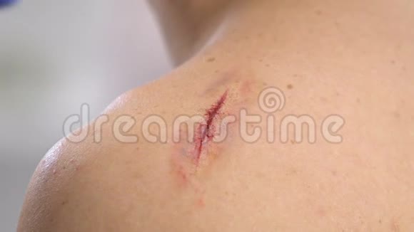 护士在抓伤的肩膀刀伤特写上用胶布包扎视频的预览图