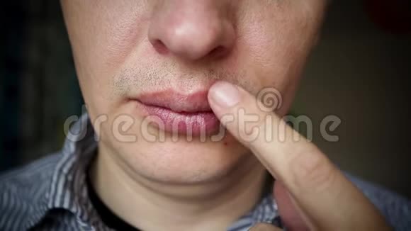 雄性上唇红色炎症和带状疱疹病毒视频的预览图