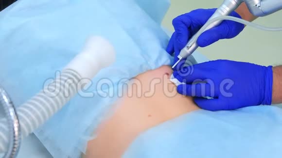 医生手术切除痣用激光在病人背部特写视频的预览图