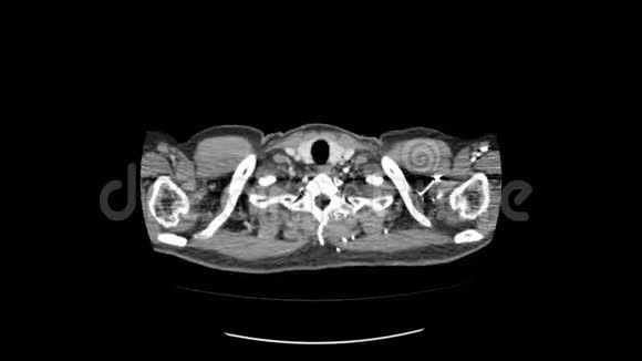 上腹部顶部CT扫描视频的预览图