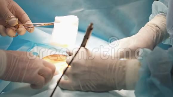 多种族的医生准备在手术中割胃视频的预览图