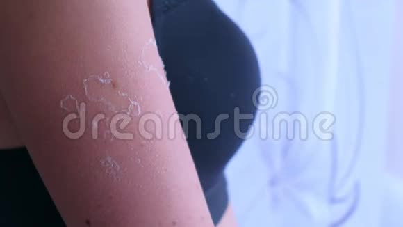 女人的皮肤剥落从紫外线晒伤的肩膀特写视频的预览图