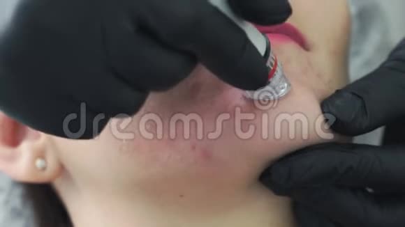美容诊所面部水剥离术中女性面部特写痤疮治疗视频的预览图