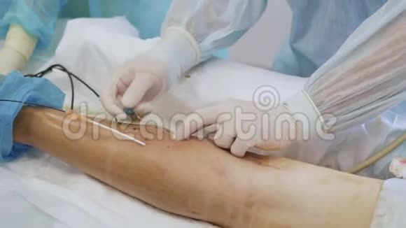 外科医生用无菌手套将针头插入病人腿部进行硬化治疗视频的预览图
