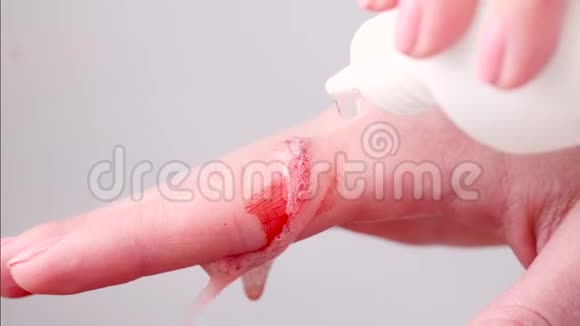 一个女人用消毒剂处理她手上的伤口视频的预览图