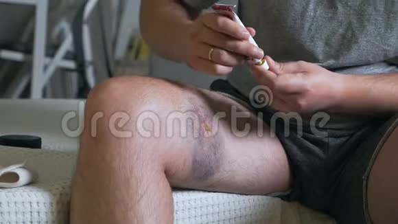 一个年轻的秃头用药膏涂抹一条疼痛的腿和瘀伤紫罗兰腿运动性足部损伤视频的预览图