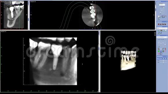 口腔医学牙科研究新质量医学牙科用咀嚼侧牙种植的实时MRI扫描视频的预览图