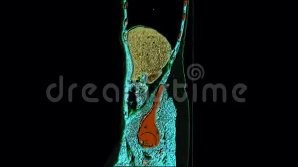 腹腔胃肠道膀胱的彩色对比MRI视频的预览图