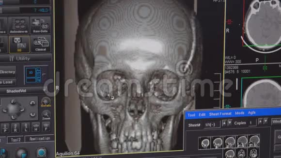 扫描监视器上显示的人头骨的过程视频的预览图