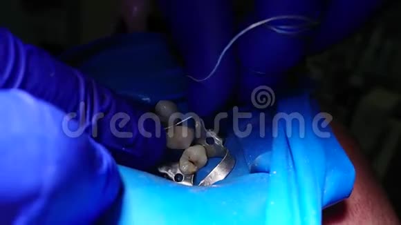 在蓝色围堰中在设置光聚合物填充后牙线在牙齿之间通过视频的预览图