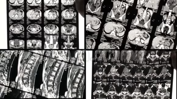 医生在核磁共振或X光检查中发现背部有问题视频的预览图