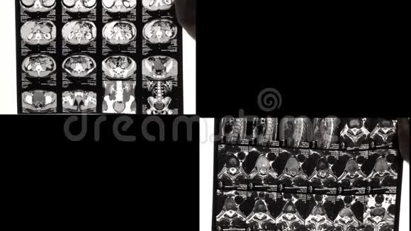医生在核磁共振或X光检查中发现背部有问题视频的预览图