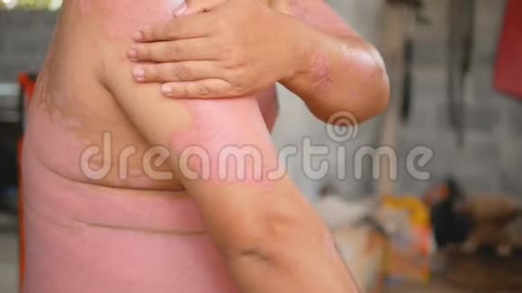银屑病患者使用草药治疗手臂上的伤口视频的预览图