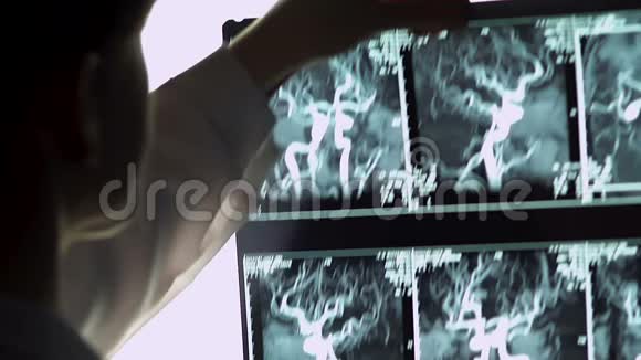 女性神经学家检查血管X线血管阻塞治疗视频的预览图