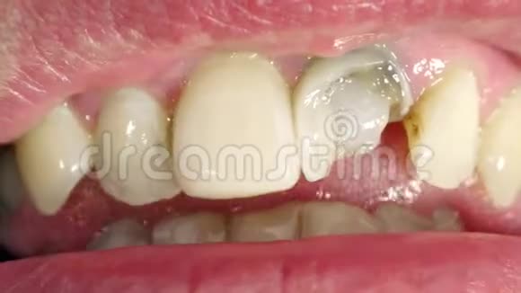 用破牙堵住嘴巴人示腔进行治疗视频的预览图