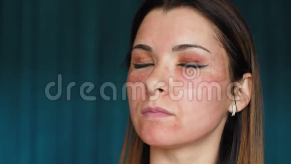 脸上有血肿的女孩分数激光美容程序的后果女性保湿脸视频的预览图