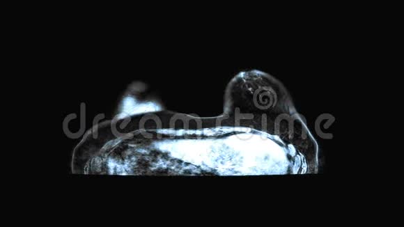 磁共振扫描屏幕乳腺癌检查视频的预览图