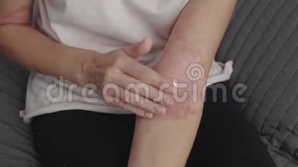 女人涂抹和谐的皮炎软膏视频的预览图