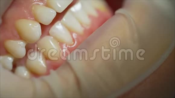 牙医在牙医那里检查病人的牙齿牙科诊所的牙齿检查视频的预览图