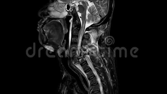 颈椎病史一名57岁男性有车辆事故史共造成脊髓损伤和脊髓损伤视频的预览图