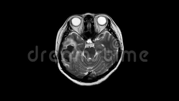 大脑和颈部的mri和mrv历史一个有虚弱和构音障碍的病例以排除中风视频的预览图
