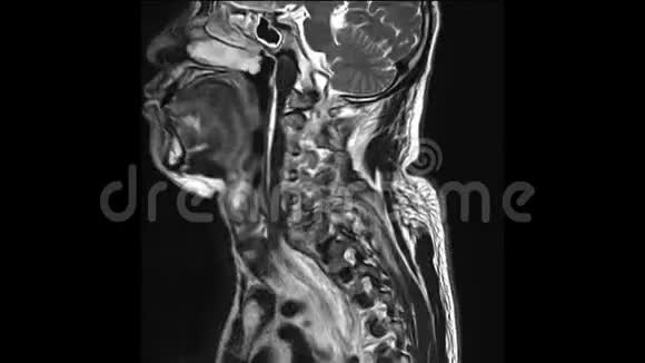 颈椎病史一名57岁男性有车辆事故史共造成脊髓损伤和脊髓损伤视频的预览图