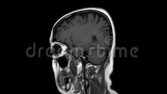 大脑和颈部的mri和mrv病史一例出现虚弱和构音障碍的病例排除中风视频的预览图