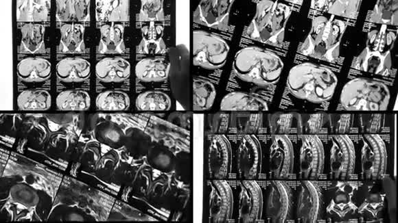 医生在核磁共振或X光检查中发现背部有问题视频的预览图