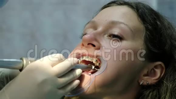 安装金属牙套特写拜访牙医牙齿矫正师用工具矫正牙齿视频的预览图