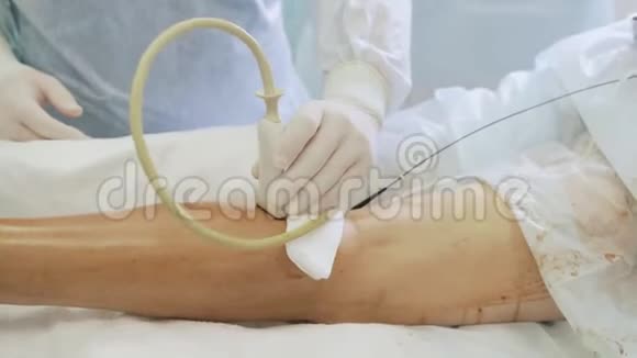 手术室硬化治疗前医生对病人腿部做超声检查视频的预览图