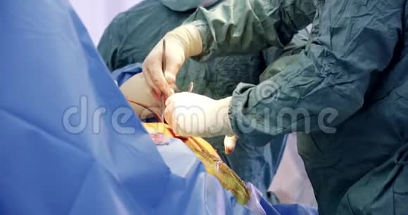 臀部外科手术的特写医学外科保健理念拍摄于红色4k10位彩色空间视频的预览图