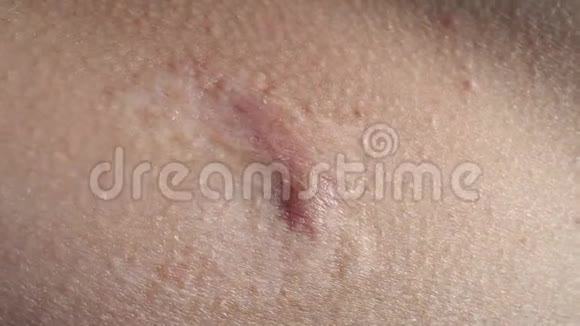 在身体上闭合瘢痕皮肤问题视频的预览图